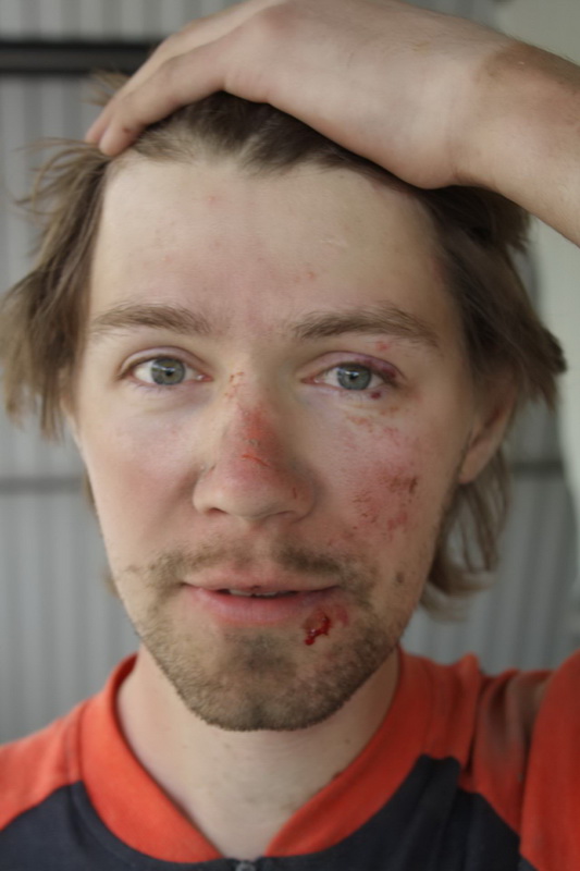 Фома с асфальтовыми повреждениями, через полчаса после падения